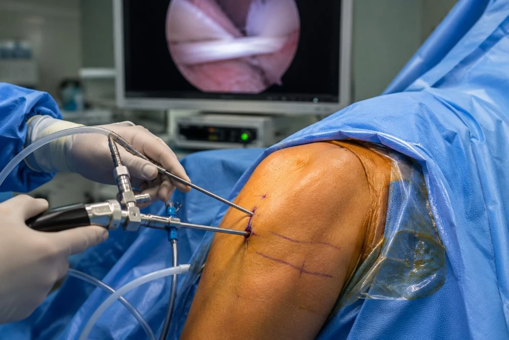 Surgeon performing arthroscopic shoulder surgery with a camera and instruments