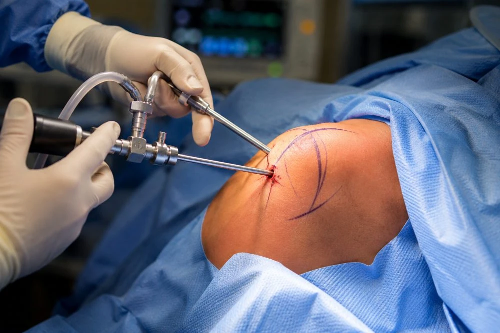 Arthroscopic shoulder surgery in progress, with instruments inserted through small incisions